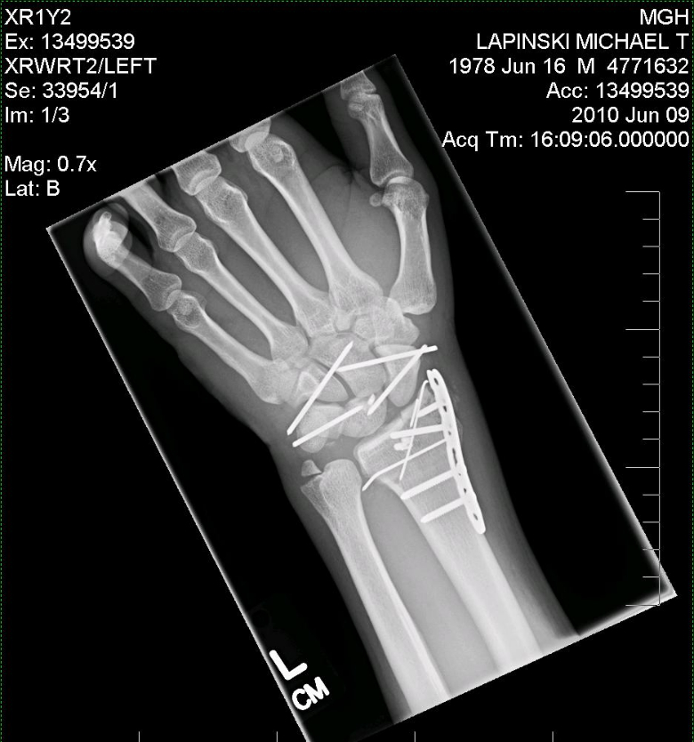 wrist braces MotoRelated Motocross Forums / Message Boards Vital MX