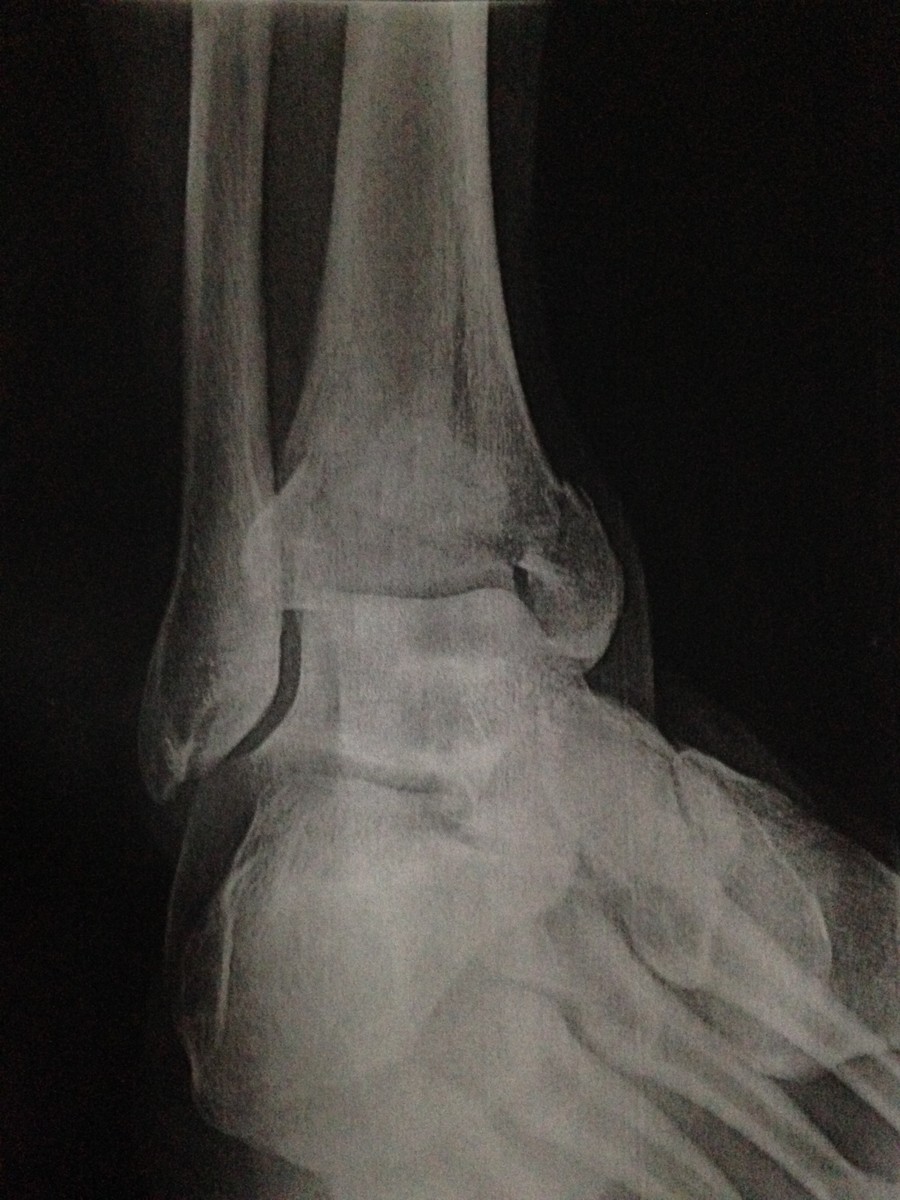 Fractured Tibia at ankle.. Would stiffer boots really helped? Moto
