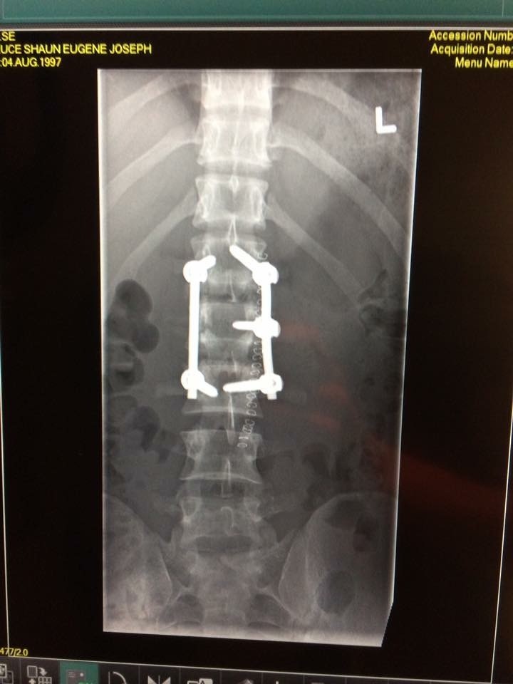 Riding after spine fusion? MotoRelated Motocross Forums / Message