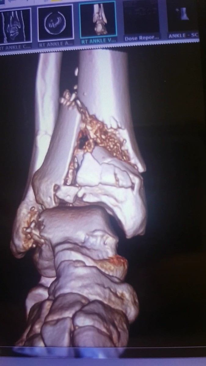 Fractured Tibia at ankle.. Would stiffer boots really helped? MotoRelated Motocross Forums