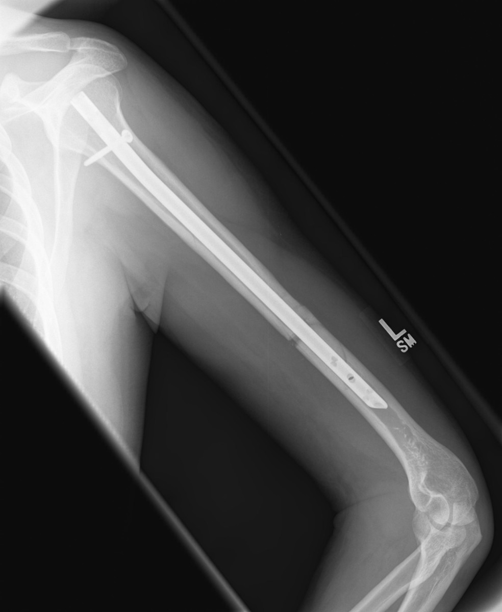 How To Rehab A Broken Humerus