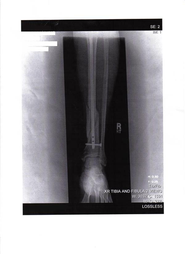 help with shin pain after tib fib fracture help with shin pain after tib fib fracture
