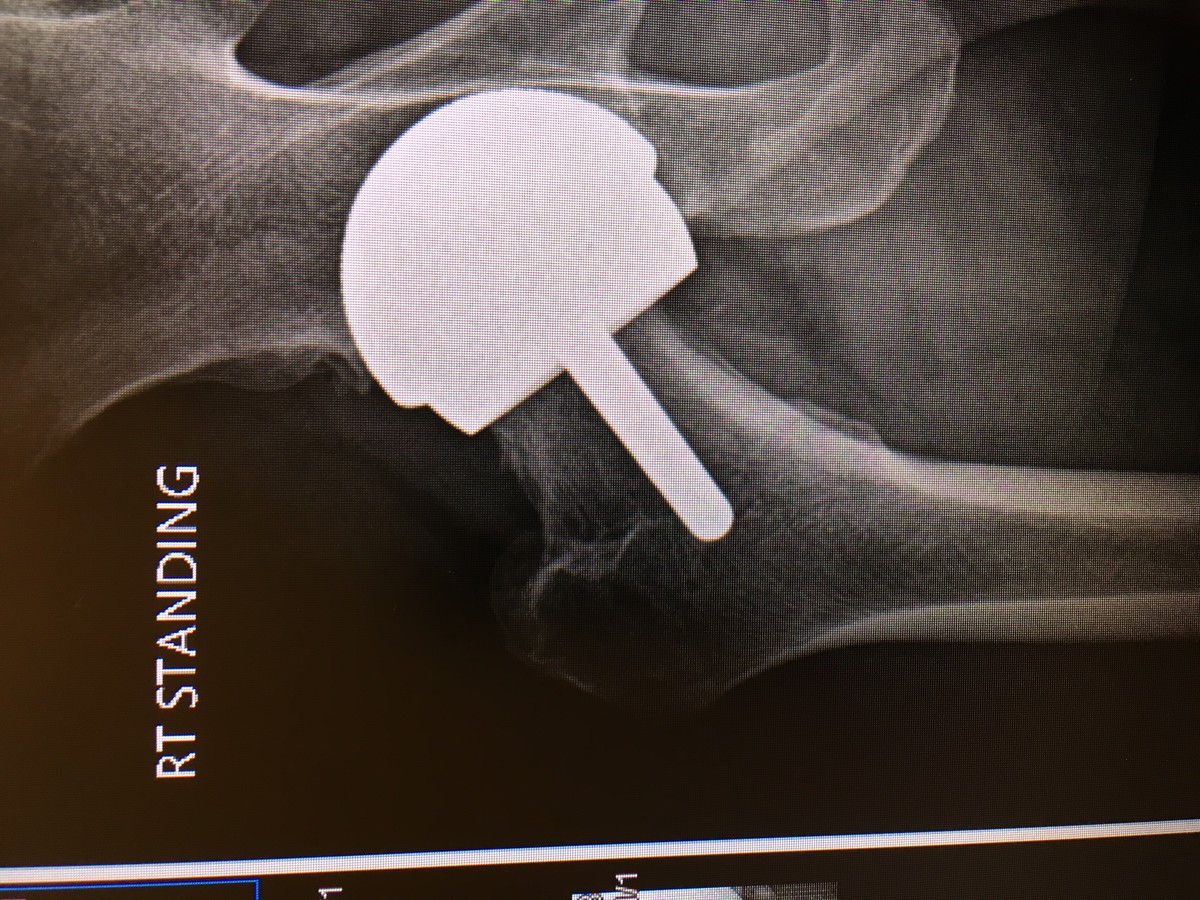 riding after hip replacement/femoral head break MotoRelated Motocross Forums / Message