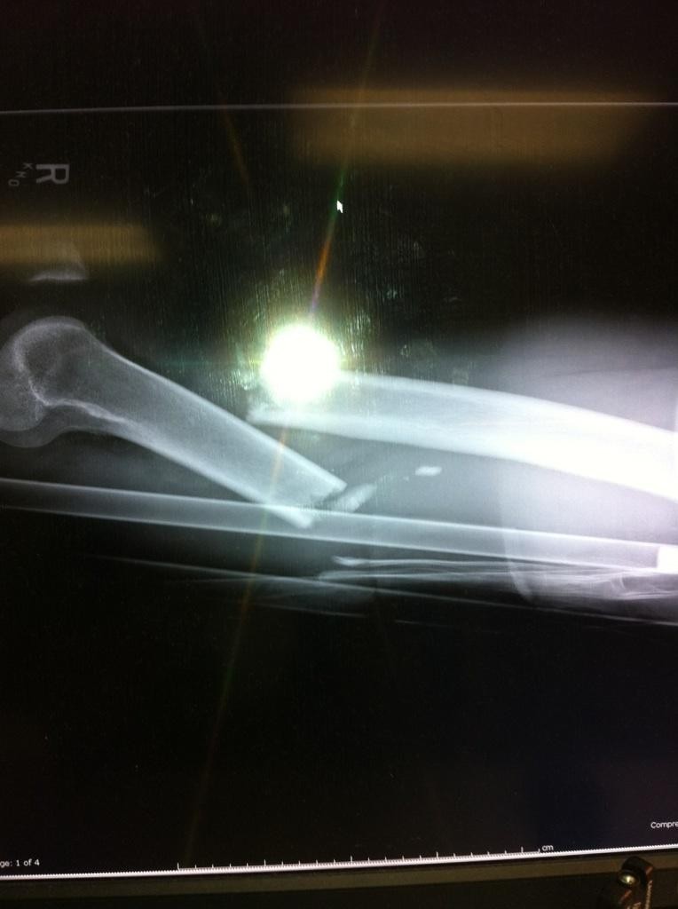 original Broken Femur 1424904288